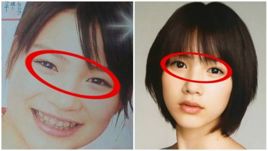 眼睑下至术是什么