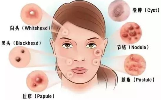 引发痤疮的原因是什么