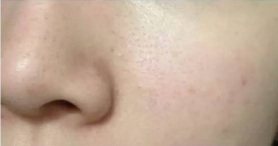脸上的黑头是怎么来的