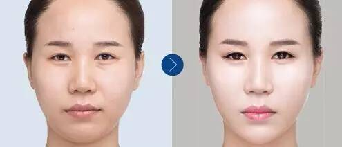 怎么去皱纹最有效