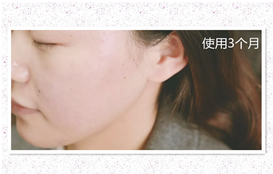 兰蔻小黑瓶祛痘印吗 兰蔻小黑瓶去痘印吗
