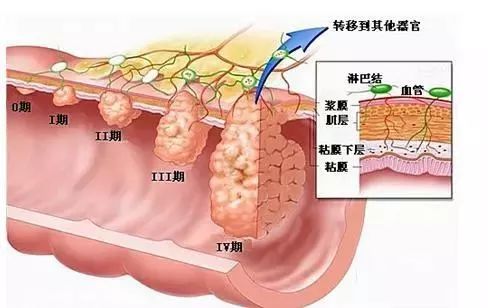 直肠癌的早期症状