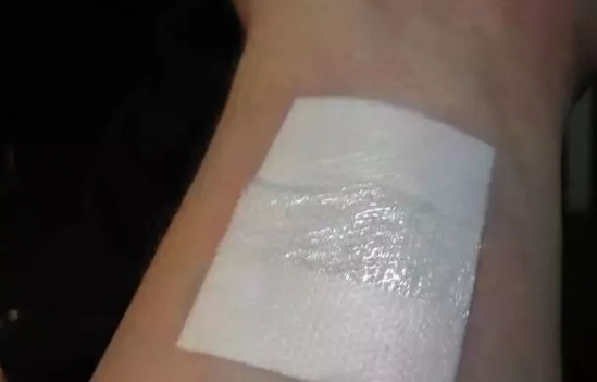 被开水烫伤怎么处理