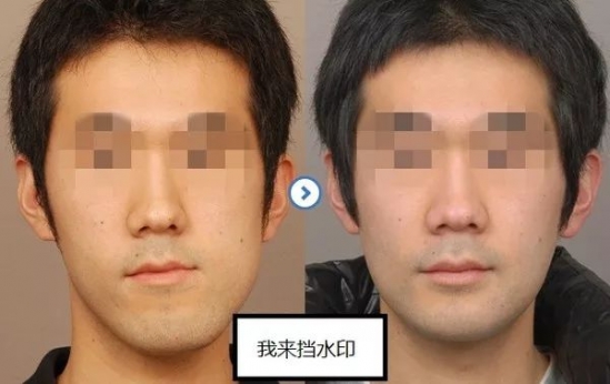 牙齿畸形分类