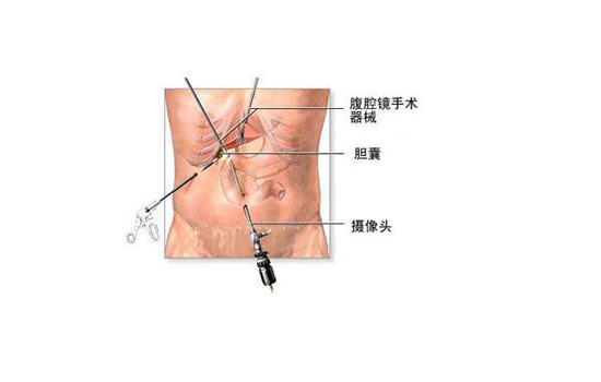 缓解胆囊疼痛的小妙招 胆囊痛怎么缓解