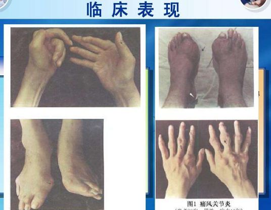 尿酸高有什么危害吗
