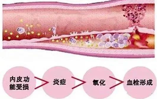 血管硬化的原因