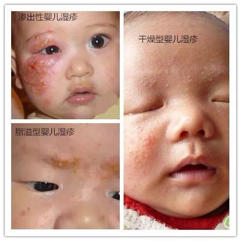 宝宝湿疹怎么护理