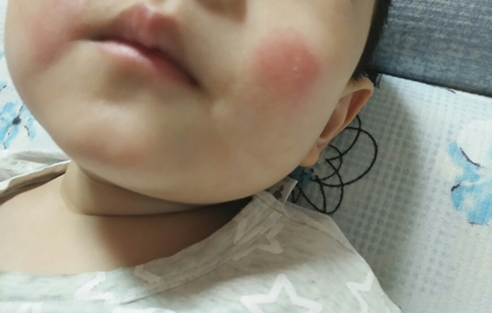 婴儿湿疹吃什么药 宝宝湿疹吃什么药好使