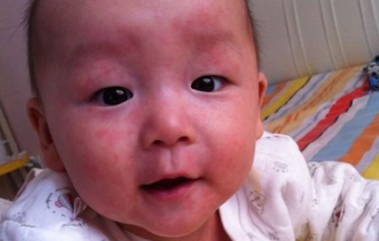 幼儿急疹传染吗 幼儿急疹有传染性吗
