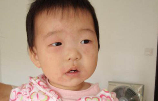 幼儿急疹传染吗 幼儿急疹有传染性吗