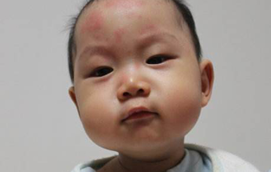 幼儿急疹爱睡觉吗 幼儿急疹孩子爱睡觉吗