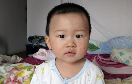 幼儿急疹出疹后几天消退 幼儿急疹几天会退掉