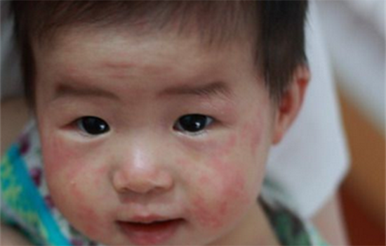 幼儿急疹和风疹的区别 幼儿急疹和风疹有什么区别