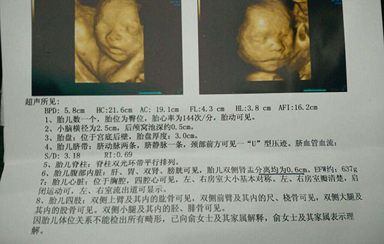 肾盂无分离是什么意思 双肾盂未见明显分离是什么意思