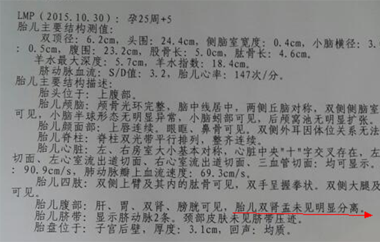 肾盂无分离是男孩女孩 肾盂无分离一定是女孩吗