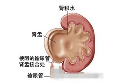 胎儿肾盂分离生下后果 肾盂分离的婴儿出生后