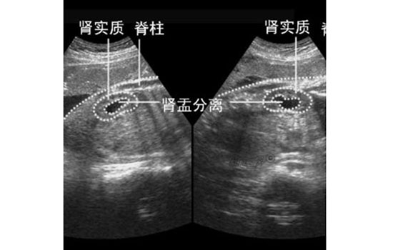 胎儿肾盂分离生下后果 肾盂分离的婴儿出生后