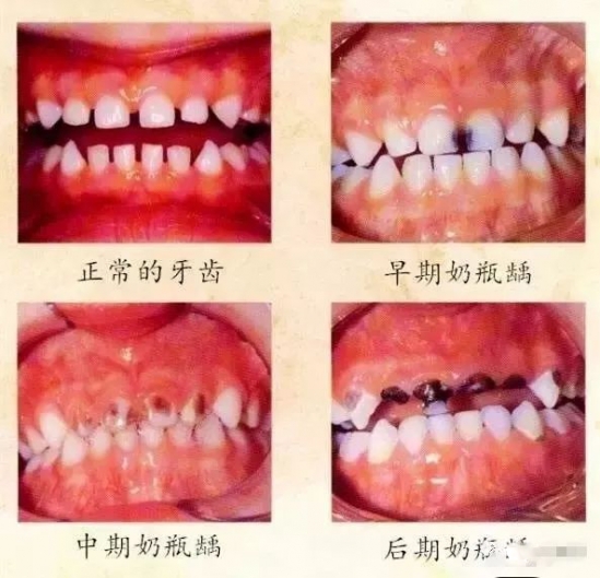 奶瓶龋怎么治疗 宝宝有奶瓶龋怎么治疗
