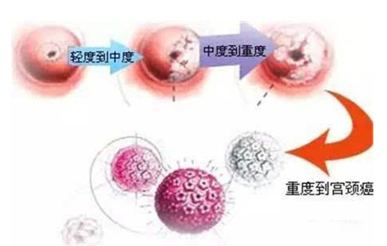 宫颈癌cin分级 宫颈cin分级