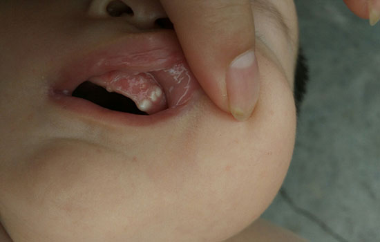 宝宝上牙龈鼓牙包图片 1岁宝宝牙龈红肿鼓包包