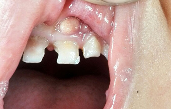 宝宝上牙龈鼓牙包图片 1岁宝宝牙龈红肿鼓包包
