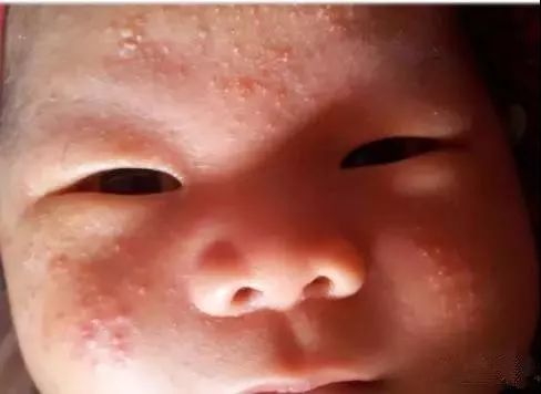 胎儿缺钙出生后会怎样