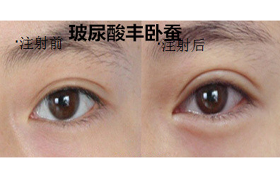玻尿酸注射卧蚕图片 玻尿酸卧蚕前后对比