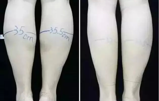 瘦腿针前后对比照片 瘦腿针前后对比