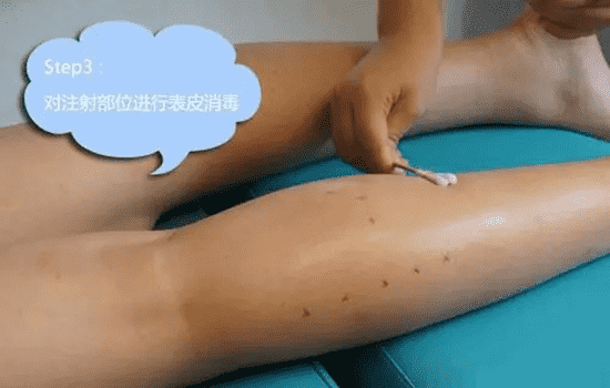 打瘦腿针过程图 瘦腿针的注射方法如下