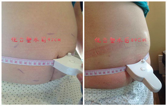 优立塑瘦腿 优立塑腿部效果怎么样