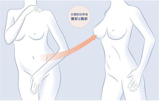 假体隆胸好还是自体隆胸好 假体丰胸好还是脂肪好