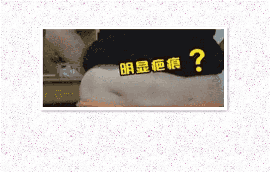 抽脂手术失败图 抽脂失败凹陷图片