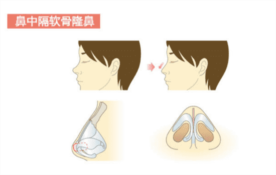 鼻综合全麻还是局麻 鼻综合是全麻吗