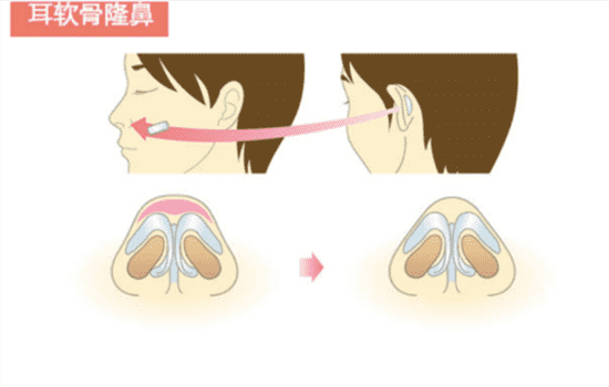鼻综合全麻还是局麻 鼻综合是全麻吗