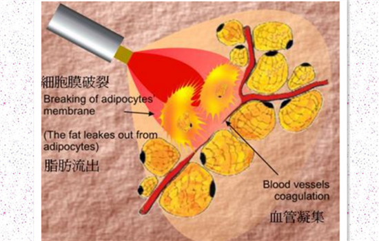 激光溶脂瘦脸多久见效 面部激光溶脂多久见效