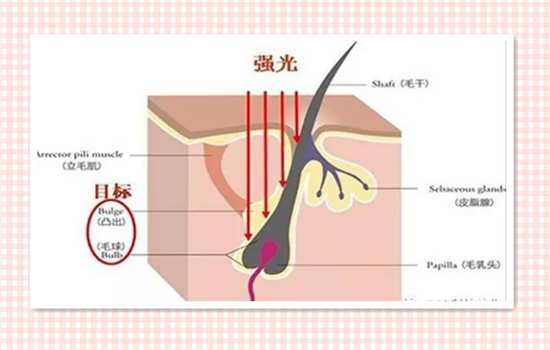 光子脱毛和激光脱毛区别 激光脱毛和光子脱毛哪个好