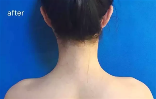 瘦肩针多久见效 瘦肩针几天见效