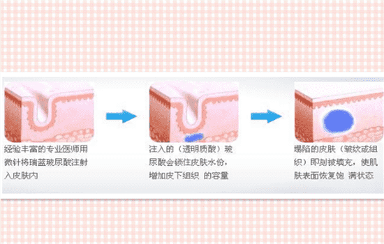 玻尿酸除皱安全性 玻尿酸除皱是否安全