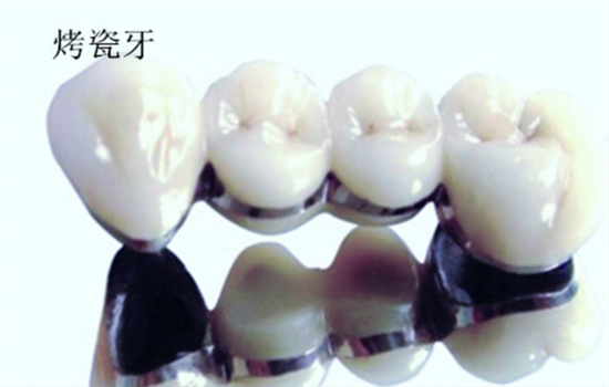 烤瓷牙牙龈发黑能治吗 烤瓷牙牙龈发黑有救吗