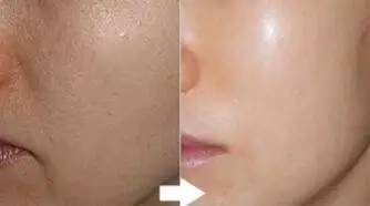 水光针副作用 水光针的作用