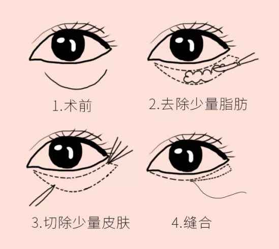 怎么样祛除眼袋