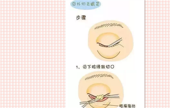 眼袋外切好还是内切好 去眼袋内切好还是外切好