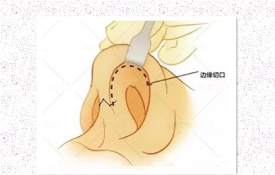 单纯隆鼻和综合隆鼻的区别 假体隆鼻和鼻综合区别
