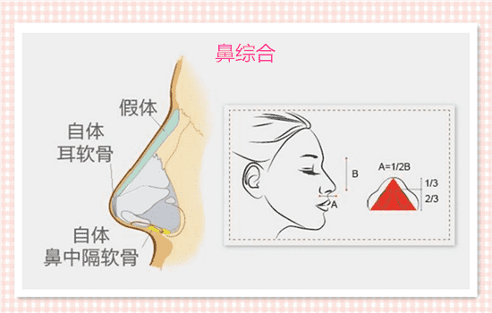单纯隆鼻和综合隆鼻的区别 假体隆鼻和鼻综合区别