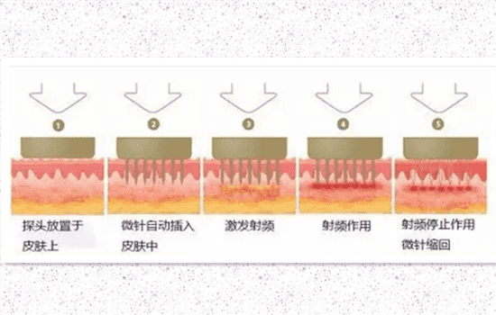 微针去痘坑效果怎么样 微针去痘坑真的有效吗
