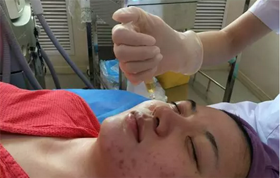 微针祛痘几次能有效果 微针去痘几次有效果
