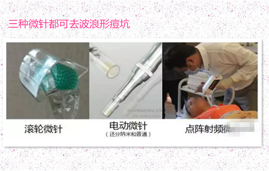 微针可以去痘坑吗 微针能去痘坑吗