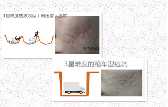 微针可以去痘坑吗 微针能去痘坑吗