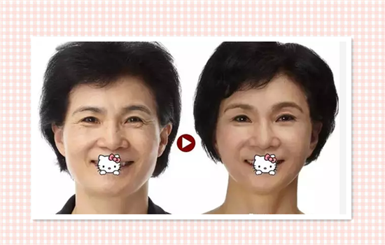 瘦脸针进口牌子有哪些 国外瘦脸针牌子有哪些
